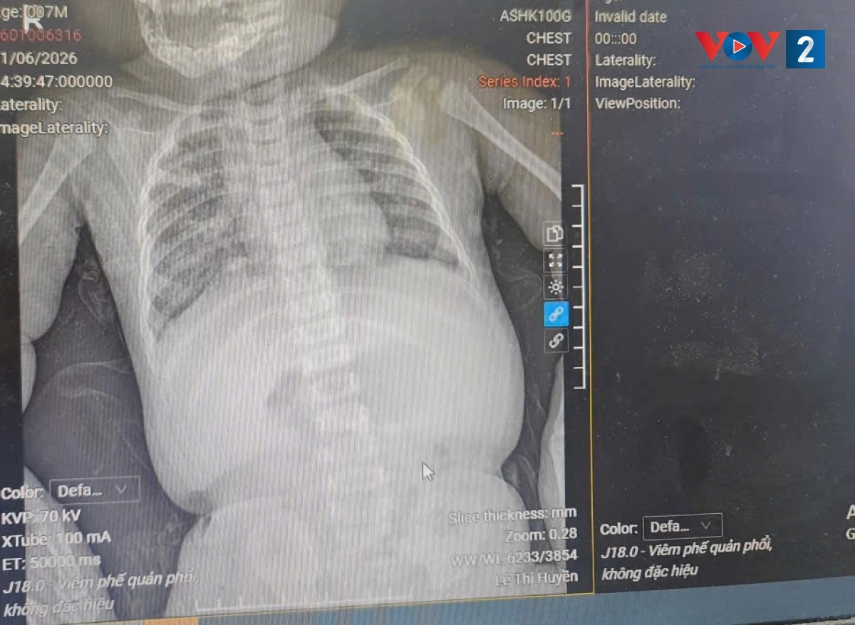 Bệnh do phế cầu ở trẻ em có chiều hướng kháng thuốc