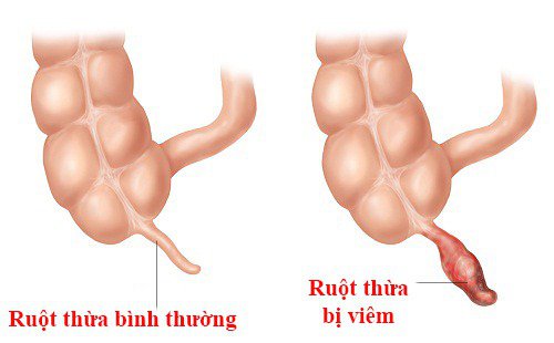 VIÊM RUỘT THỪA Ở TRẺ EM: NGUYỄN NHÂN, TRIỆU CHỨNG VÀ CÁCH XỬ TRÍ.