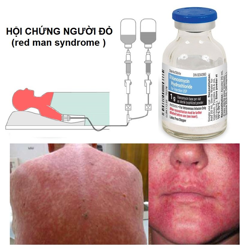 HỘI CHỨNG NGƯỜI ĐỎ LIÊN QUAN CÁCH TRUYỀN VANCOMYCIN