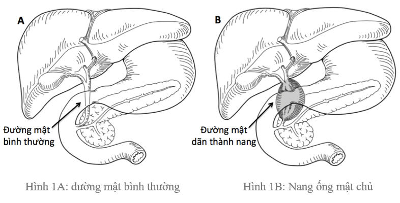 Phẫu thuật nội soi một đường rạch qua rốn điều trị nang ống mật chủ thường gặp ở trẻ em