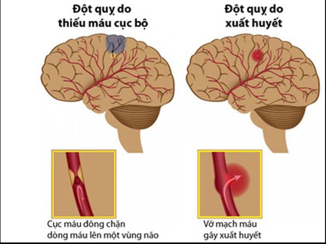 KỸ THUẬT TIÊU SỢI HUYẾT TRÊN BỆNH NHÂN NHỒI MÁU NÃO CẤP